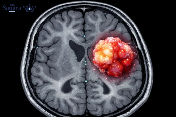 علائم گانگلیوگلیوما و گانگلیوسیتوما