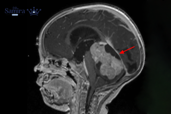 عوامل تشدید کننده بیماری مدولوبلاستوم