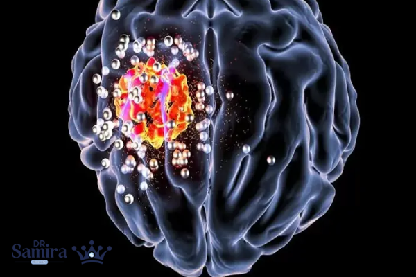 متاستاز مغزی چیست