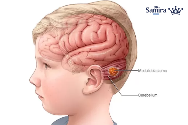 مدولوبلاستوم چیست؟
