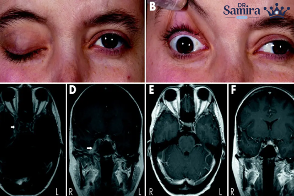 نقش ژنتیک و عامل خطر در ایجاد مننژیوم