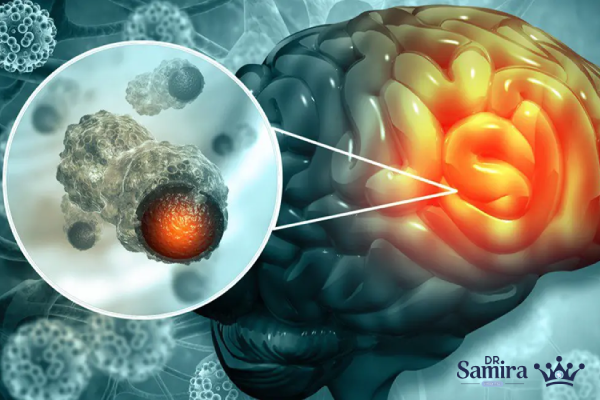 چرا درمان ایمنی در تومورهای مغزی دشوارتر است؟