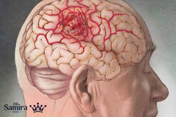 کورویید پلکسوس چیست و چه نقشی در مغز دارد؟