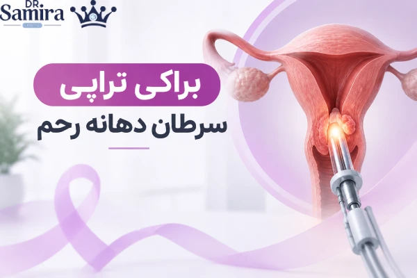 براکی تراپی سرطان دهانه رحم